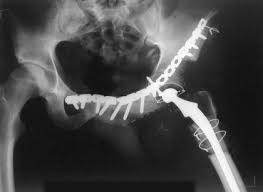 Chondrosarcoma is a cancer that can begin in the bones or tissue near bones, often in the hip, pelvis, and shoulder. Pelvic Chondrosarcomas Surgical Treatment Options Sciencedirect