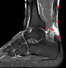When this bony enlargement rubs against the achilles tendon and overlying bursa, inflammation of the retrocalcaneal bursa occurs. Achilles Tendon Pathology Radsource
