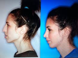 Often, “medical necessity” is difficult to establish and substantiate. Before And After Pictures Of Jaw Surgery Oral Surgery Boca Delray