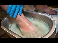 как сделать мазь от грибка ногтей из яйца и уксуса Gribok Otsohnet S Kornem Vozmi Da Namazh Nogi Obyknovennoj Youtube Domashnie Sredstva Naturopatiya Lichnaya Gigiena