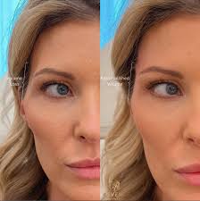 What Does Putting Filler in Your Temples Do? A Complete Guide to Temple  Fillers.