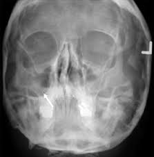 Image result for Sinus X Ray