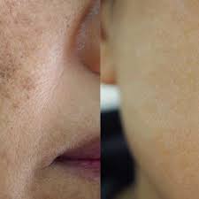 What's the best way to remove brown spots on face? How To Remove Dark Spots From Your Skin Kama Ayurveda