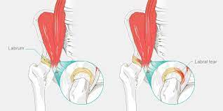 Snapping Hip Syndrome The Complete Injury Guide Vive Health