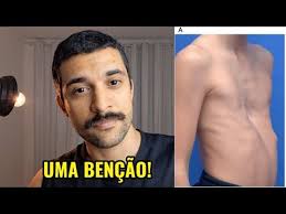 Pectus Excavatum com Costela Saltada é o Melhor Pectus