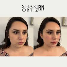 Shari Ortiz (@aesthetic_nurse_shari) · Chino, CA