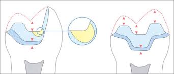 Ceramic Inlays Pocket Dentistry