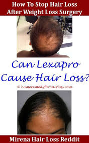 Hair loss treatments and their effects depend mainly on the cause of the hair loss. Pin On Hair Loss Tips