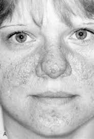 LASER TREATMENT OF WARTS AND OTHER EPIDERMAL AND DERMAL LESIONS