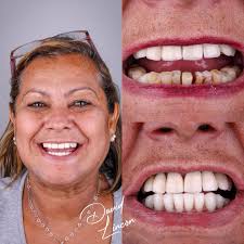 ✨ Transformação em um único dia! ✨ Hoje queremos compartilhar a história de  uma paciente especial que passou por uma incrível transformação. Com um  sorriso que antes afetava sua confiança, ela optou