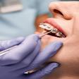 Orthodontic Braces product image
