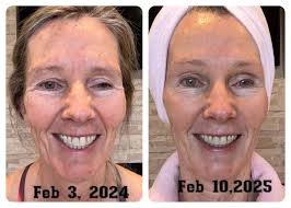Wow!!! Check out her 1 year results with this skincare🤩 For the majority  of the time, this gal used the Expert Line, but now with the dry, cold  winter in Alberta, she's