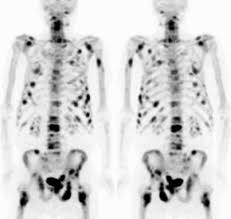 The earlier the detection of prostate cancer, the better the patient's chance of survival is. How Much Is Prostate Cancer Treatment Cost In India Quora