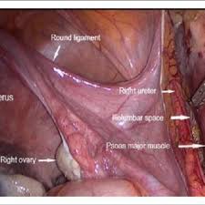 Laparoscopy, with its advantages and limitations, requires a different topographic comprehension of surgical anatomy, adapted to a certain angle of vision and magnification. Pdf Laparoscopic Evaluation Of Female Pelvic Neuroanatomy And Autonomic Plexuses In Terms Of Gynecologic Perspective