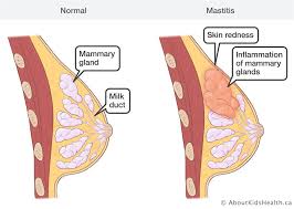 Mastitis is an infectious disease condition resulting in an inflammatory reaction in the mammary gland of the cow. Breast Changes And Conditions