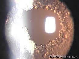 Yag Laser Augenoperationen