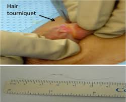 As hair grows back through the skin, any kind of obstruction can. Https Ispub Com Iju 6 1 5069