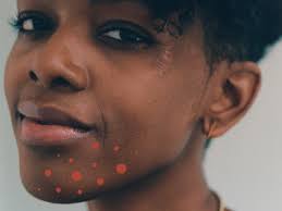 According to a 2016 article, swelling of the nose can occur within. Cystic Acne Treatment What S Up With Those Large Painful Pimples That Won T Go Away Self