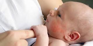 Karena setelah bayi menyusu, biasanya akan langsung buang air. Ruam Susu Pada Bayi Disebabkan Asi Simak Penjelasan Berikut Ini Theasianparent Indonesia