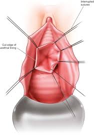 Image result for Urethral Prolapse