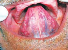Image result for Sublingual Varices