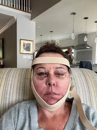 Scheduled for surgery tomorrow-how painful is deep plane? Feeling nervous  now!