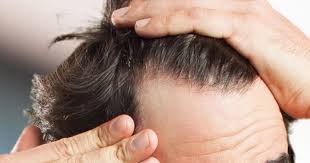 Keturunan keturunan adalah punca utama terjadinya masalah tumbuh uban ketika usia muda. Orang Lelaki Elak Gayakan Rambut Dengan Kerap Boleh Botak Di Awal Usia Keluarga