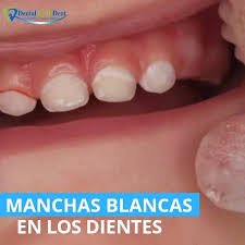 Dental Gym Dent Manchas Blancas En Dientes De Leche Cuando Pensamos En Caries Automaticamente Pensamos En Un Huequito Marron O Negro Sabian Que La Caries Se Inicia Con Una Mancha