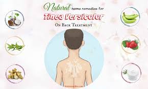 It is one of the best treatments for tinea versicolor and often cures the problem permanently, but can take a long time to work. 35 Home Remedies For Tinea Versicolor On Back Treatment