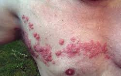 Image result for herpes zoster