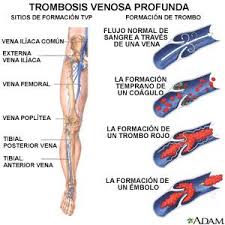 Es una de las principales emergencias médicas. Dr Alex Que Es La Trombosis Venosa Profunda La Trombosis Venosa Profunda Tvp Es Un Coagulo De Sangre Que Se Forma En Una Vena Profunda Del Cuerpo Las Venas Profundas En