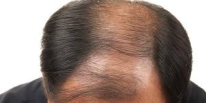 For determination of the exact cause and its treatment, one needs to consult a medical practitioner. Itchy Scalp And Hair Loss Causes Treatments And Prevention Tips