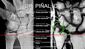 Comparison Of Diaphyseal And Metaphyseal Ulnar Shortening Osteotomies For  The Treatment Of Ulnar Impaction Syndrome | Bmc Musculoskeletal Disorders |  Full Text