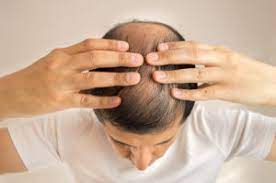 Alopecia areata may be hereditary and isn't contagious. Hair Loss Specialist In Charlotte Nc Best Hair Loss Transplant Doctor