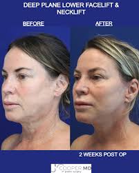 CHECK OUT THE JOWLS & NECK! This 54 year old woman was unhappy with her  sagging jowls and crepey neck skin. Dr. Cooper performs a  #deepplanefacelift and #deepplanenecklift to achieve these beautiful