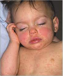 The illness causes an itchy rash that usually forms between 200 and 500 blisters over the entire body, headaches, coughing, and fussiness. Adverse Reaction To Mmr Immunization Consultant360