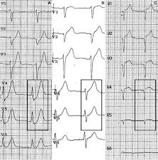 Quadruple nosepiece revolves on ball bearing. De Winter S Pattern An Unusual But Very Important Electrocardiographic Sign To Recognize Sciencedirect