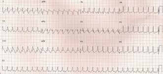 Looking for the definition of svt? Svt With Rbbb Supraventricular Tachycardia With Rbbb