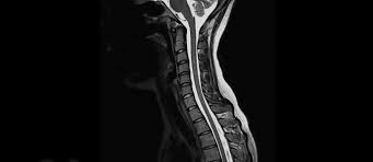 Ob eine untersuchung der hws mittels ct oder mrt durchgeführt werden sollte, richtet sich nach der fragestellung. Mvz Diagnostikzentrum Radiologie Marburg Mrt Hws