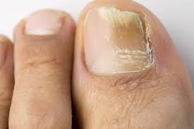 7 your nails thrive in a dry, clean environment. How To Treat Toenail Fungus