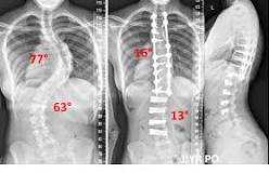 Image result for what is current treatment for scoliosis