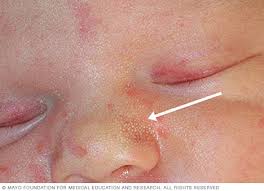 Your care provider dries your baby off, puts a hat on him or her, covers him or her with a warm blanket, and gets your baby settled on your chest. Milia Symptoms And Causes Mayo Clinic