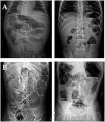 The Significance Of Abdominal Radiographs With Paucity Of Gas In Pediatric Adhesive Small Bowel Obstruction The American Journal Of Surgery