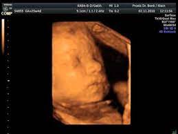 3d Ultraschall In Der 26 Ssw Baby Youtube