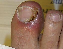 Image result for Pitting nails feet