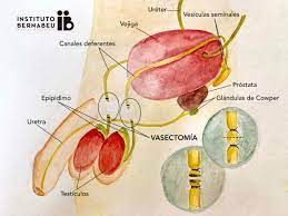 Durante la vasectomia senza bisturi, il dottore, per prima cosa, cerca i dotti deferenti sotto la pelle dello scroto e li tiene fermi con. La Vasectomia El Anticonceptivo Masculino