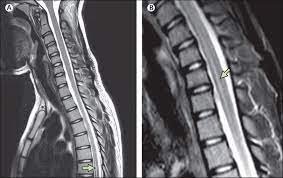 Transverse myelitis is a neurological disorder that damages myelin, the material covering nerve cell fibers. Acute Myelitis Due To Zika Virus Infection The Lancet