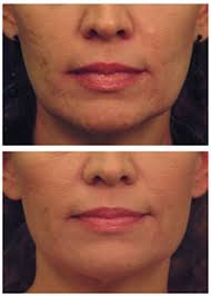 Does skin tightening without surgery work? Raleigh Skin Care Laser Skin Tightening