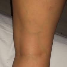 Sieht Das Nach Einer Thrombose Aus Gefahr