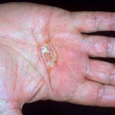 Image result for dyshidrosis